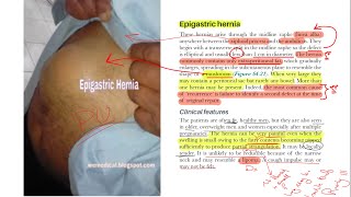 Hernia surgery part 6  Other types  Epigastric Spigelian Lumbar Trumatic Hernias [upl. by Yleoj]