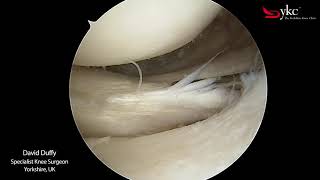 Watch a Knee Surgeon Treat a Meniscal Tear [upl. by Hylton34]