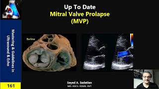 Mitral Valve Prolapse MVP [upl. by Nered]