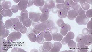 Plasmodium falciparum ring form in thin blood smear [upl. by Ymmat973]