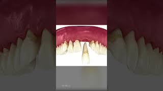 Why Do We Lose Teeth Periodontitis Explained [upl. by Nazler836]