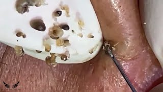 Cystic Acne Blackhead Removal  Elderly Hidden Acne Treatment  Pimple Popping Spa Extraction  060 [upl. by Adianes]