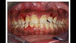 Necrotizing ulcerative gingivitis [upl. by Lorenzana25]