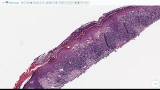 Lecture 3Lichenoid Interface Dermatitis [upl. by Ennaeel]