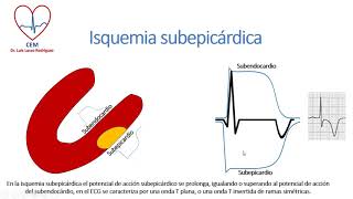 Isquemia lesion y necrosis [upl. by Aynos]