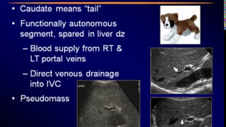 Sonography of the Liver [upl. by Rbma]