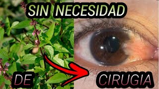 REMEDIO CASERO PARA QUITAR PARA SIEMPRE LA CARNOSIDAD EN LOS OJOS SIN NECESIDAD DE CIRUGIA ✅😱 [upl. by Stouffer]