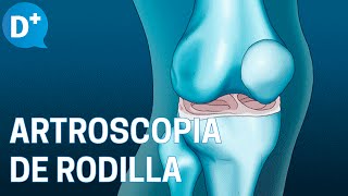 ¿En qué consiste la Artroscopia de rodilla [upl. by Sigismond]