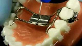 Bracesquestionscom  Orthodontic Jaw Expander How to Turn [upl. by Sucramej371]