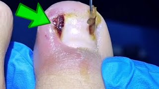 Toenail Is Seriously Infected and Has Pus Pedicurist Dig Out Deep Ingrown Toenails [upl. by Ygief]