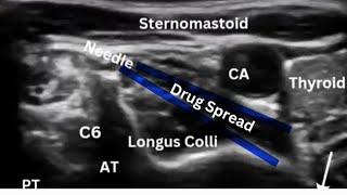 Stellate Ganglion Block for CRPS [upl. by Buehler]