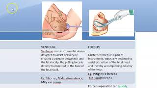 Obstetrics 684 Ventouse vs Forcep Delivery advantage difference vacuum assisted operative instrument [upl. by Yerhcaz]