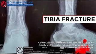 Comminuted Tibia Fracture [upl. by Ylimme581]