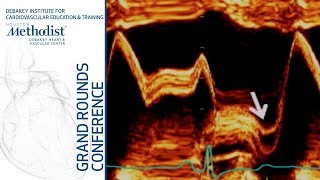 Update on Mitral Valve Prolapse A Jamil Tajik MD January 24 2019 [upl. by Seleta]