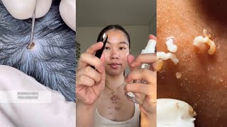 40 Minutes Of Top ASMR Pimple Popping Video [upl. by Idolah982]