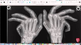 Introduction to Imaging of Arthritis [upl. by Haynor]