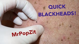 Quick and easy blackhead extractions Imbedded plugs removed with ease [upl. by Ahsiadal969]