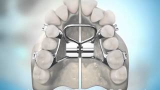 Surgically Assisted Palatal Expansion [upl. by Bhatt]