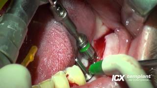 Dental Implantat Zahn 36 und 37 [upl. by Alfonso]