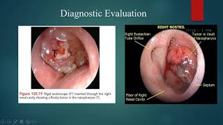 Nasopharyngeal CarcinomaNPC 4th yr Lecture 1882020 [upl. by Clarissa]