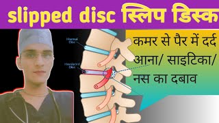 slipped disc symptoms treatment cause  sciatica full explanation [upl. by Yregerg]