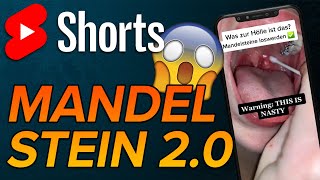 Mandelstein selber entfernen shorts [upl. by Antonella575]