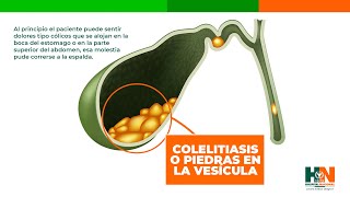 COLELITIASIS O PIEDRAS EN LA VESÍCULA [upl. by Stoneham]