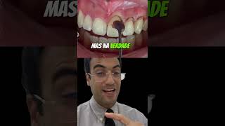 DENTES CURTOS drmiltonresponde [upl. by Notla]