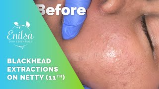 Blackhead Extractions on Netty  11th Treatment [upl. by Ayimat]