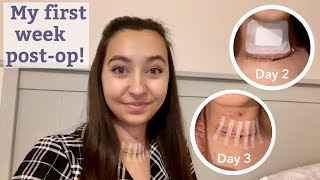 Thyroid Surgery Recovery vlog  Day 2 3 4 amp 6 Postop  week 1 [upl. by Kcirdle18]