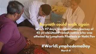 Lymphedema Elephantiasis  Filariasis  Lymphedema Treatment [upl. by Judson]