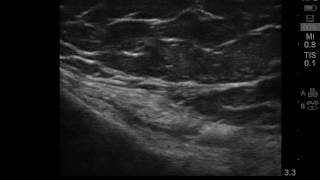 Ultrasound guided pes anserine bursitis injection [upl. by Beltran]