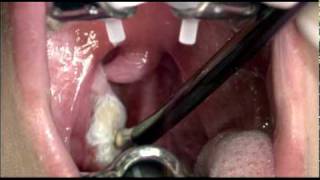 Tonsil Cryptolysis to Address Tonsil Stones [upl. by Rica]