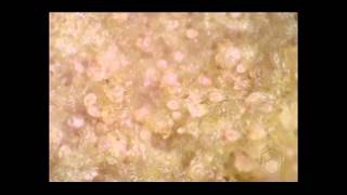 Scabies mites on skin crust [upl. by Klein]