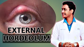 external hordeolum eyelid diseases external hordeolum case presentation 2021 [upl. by Eki287]