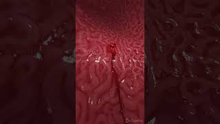 Beelding gastric ulcer 3d animation anatomy meded [upl. by Trembly]