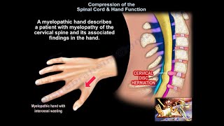 Compression of the Spinal Cord amp Hand Function  Everything You Need To Know  Dr Nabil Ebraheim [upl. by Clareta]