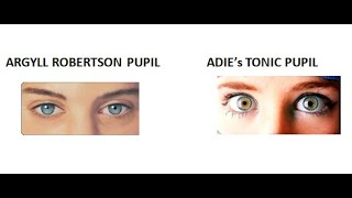 Ophthalmology 326 Argyll robertson pupil Adies tonic pupil neurosyphilis difference pilocarpine test [upl. by Melton637]