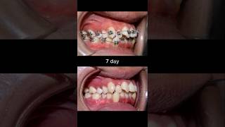 Evolution Of Braces 30 months braces orthodontist dentist dental [upl. by Atnwahsal777]