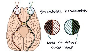 Lesions of the Visual Pathway [upl. by Bashuk314]