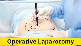 Operative Laparotomy the Opening [upl. by See]