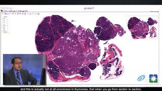 Pathology Insights Basics of Thymic Pathology with Sanjay Mukhopadhyay MD [upl. by Halette]