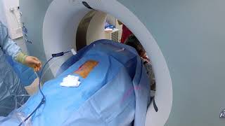 Renal tumour microwave ablation under CT guidance [upl. by Tawney223]