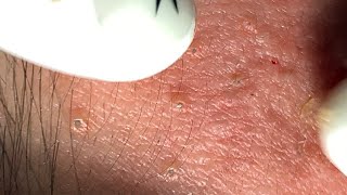 Acne Treatment 137  Blackheads and Papules  Inflammatory Acne [upl. by Yetnruoc]