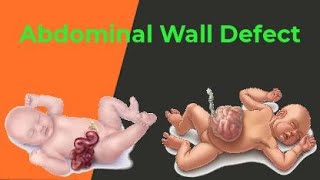 Abdominal Wall Defect with Animation by Ashish Kumar Nursingvideo [upl. by Eeroc821]