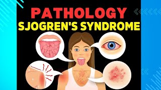 24 Sjogren Syndrome and Scleroderma [upl. by Xxam]