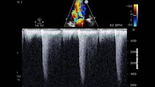 Mitral stenosis measurements [upl. by Kcirddet]