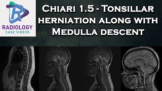 Chiari 15  Tonsillar herniation along with Medulla descent [upl. by Laflam]