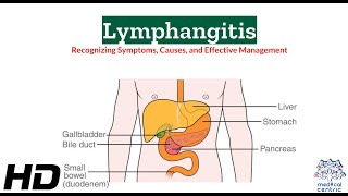 Lymphangitis 101 A Comprehensive Guide to Symptoms and Effects [upl. by Atiz]