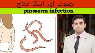 Enterobiasispinworm infection amp Treatmentچمونے اور ان کا علاج Series of common opd cases [upl. by Leong]